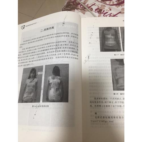 脊柱側彎的保守治療